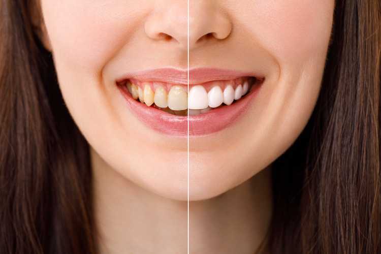 Best Teeth Whitening Kits